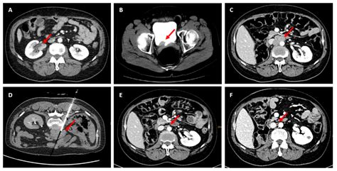 Lynch Syndrome: Its Impact on Urothelial Carcinoma