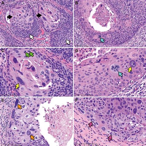 Clinical Outcomes of Pleomorphic High-grade Squamous Intraepithelial Lesions of the Uterine ...