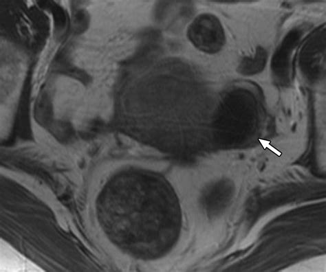 Susceptibility-Weighted MRI of Endometrioma: Preliminary Results | AJR