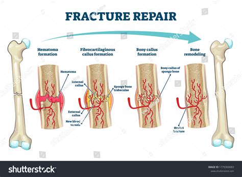 Image result for Bone Healing Process
