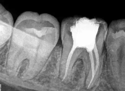 What are key Predictors of Early Endodontic Treatment Failure after ...