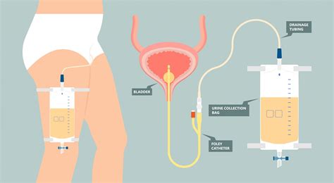 How To Use Urinary Catheter at Kai Chuter blog