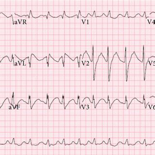 Image result for AFib Detection Algorithm