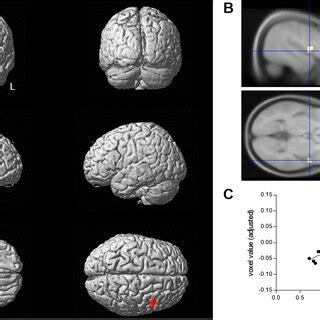 Statistical Parametric Mapping 的图像结果