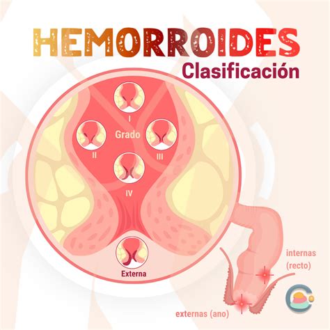 Hemorroides: todo lo que debes saber - Pocimas de salud