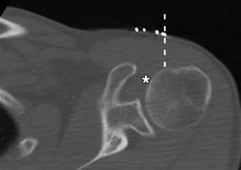 CT-Guided Shoulder Arthrography at the Rotator Cuff Interval | AJR