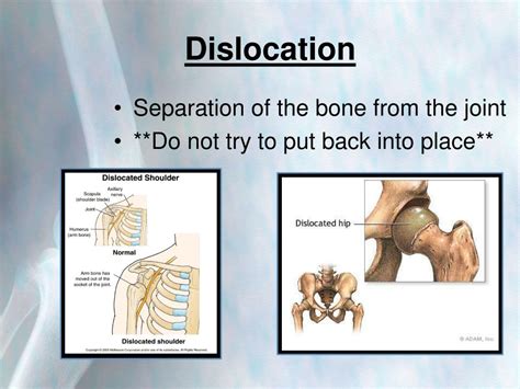 Image result for Dislocation First Aid