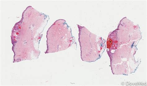 Angiokeratoma Of Fordyce