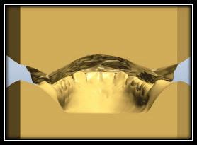 Image result for How to Take Study Models with Plaster Lab