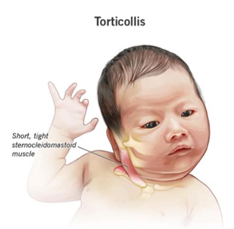 Torticollis: Causes, Symptoms, and Treatment Guide