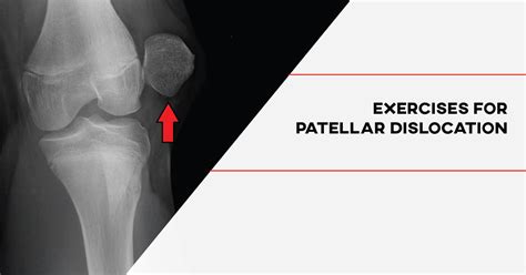 Image result for Patellar Dislocation Exercises