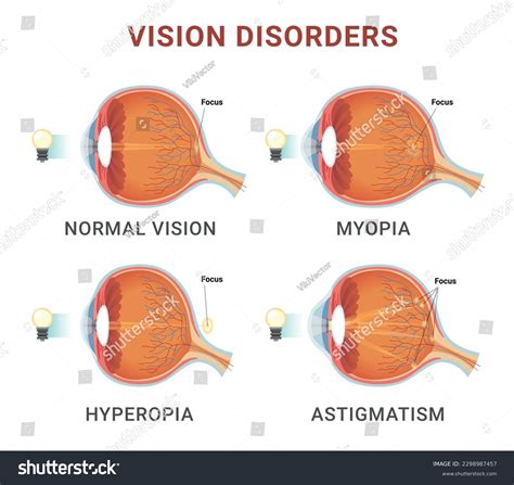 5,411 Vision Disorders Images, Stock Photos, 3D objects, & Vectors | Shutterstock