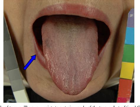 Figure 3 from Tongue diagnosis of traditional Chinese medicine for ...