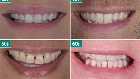 Scientists Found an Unexpected Sign of Human Longevity—Our Teeth