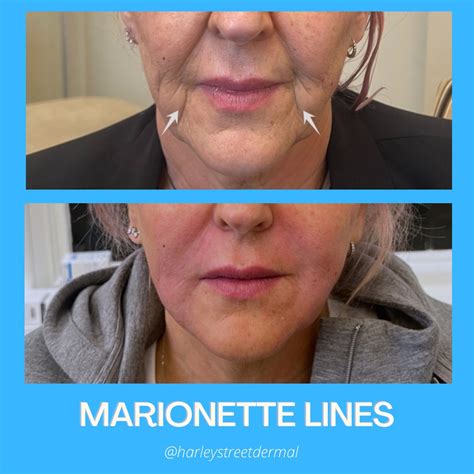 Marionette Lines Treatment in London | Harley Street Dermal