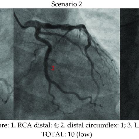 Image result for Syntax Score