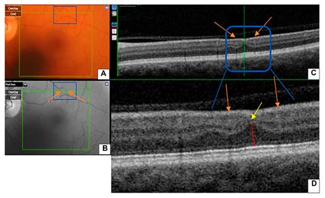 Retinal Ischemic Perivascular Lesions: An Exploratory Study of Their ...