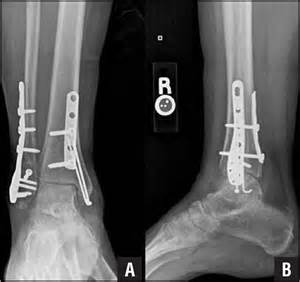 Open Reduction and Internal Fixation of Posterior Malleolus Fractures via a Posteromedial Approach