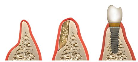 Bonegrafting | 3D Dental & Implant Clinic