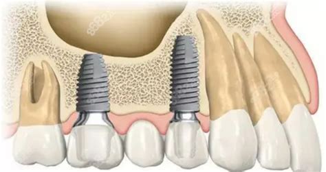 IMPLANTOLOGÍA DE CLASE MUNDIAL (Straumann dental implant system)