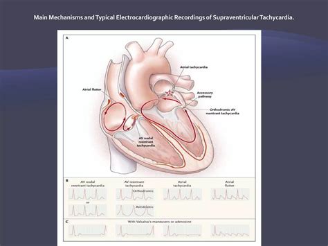 Supraventricular tachycardias | PPTX