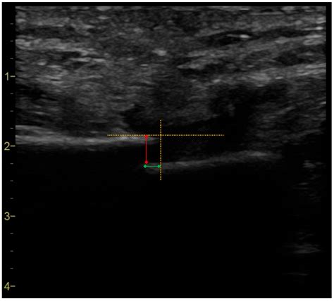 Reliability of Ultrasonographic Assessment of Sternal Micromotions by ...
