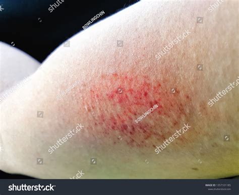 Bruising Bleeding Caused By Scratching Due Foto Stok 1357101185 | Shutterstock