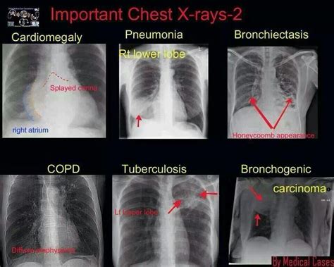pneumonia x ray