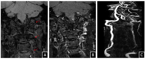 Vertebral Artery Dissection