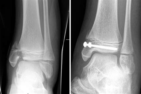 Orthokids Ankle Fractures