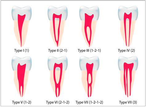 Evaluation of Root Canal Configuration of Maxillary and Mandibular ...
