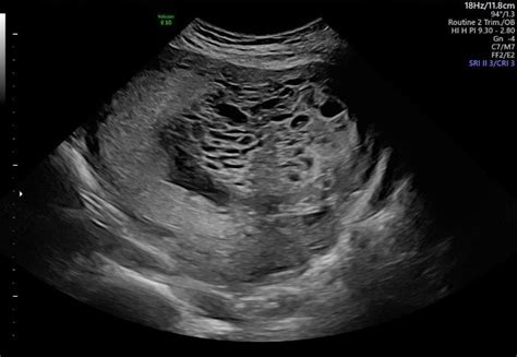 Complete hydatidiform mole with concurrent fetus: Two cases of live, term birth coupled with ...