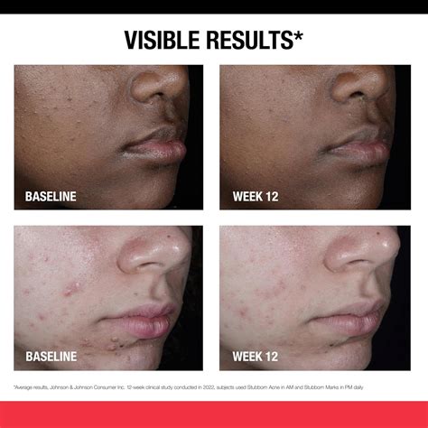 Neutrogena Retinol SA, Stubborn Marks PM Treatment, India | Ubuy