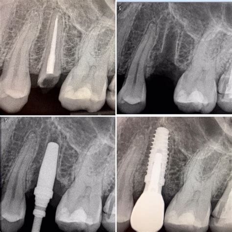 Dental Implant Case of The Day | Dr. Gentry