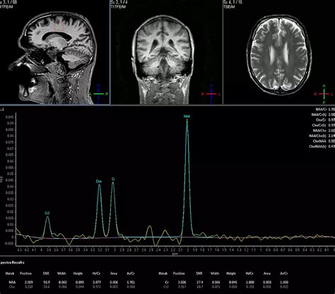 Philips - Spectroscopy - Brain MR Clinical application