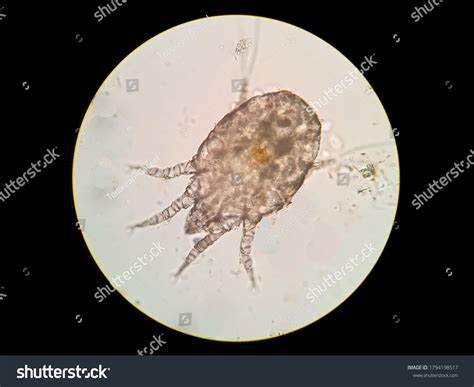 Ear Mite Human