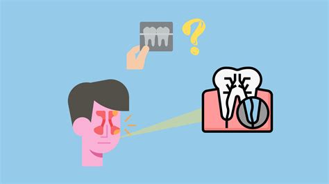 How can a failed root canal cause a sinus infection (X-ray pictures)?