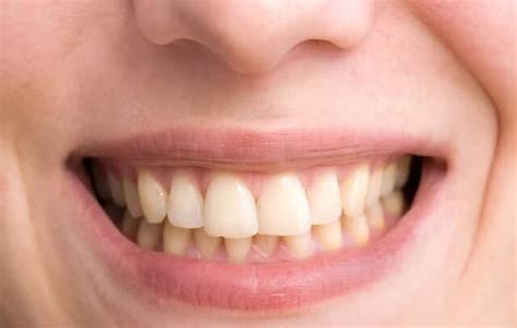 Sugar Effects On Teeth: చక్కెర ఎక్కువగా తింటే పళ్లు పసుపు రంగులోకి ...