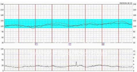 Image result for Absent Variability