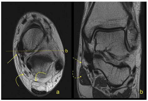 The Flexor Retinaculum Connects the Surrounding Structures into the Medial Ankle Complex