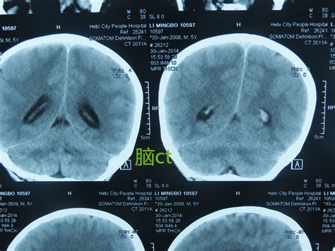 最近总是头疼，做了脑CT，有一条说是脑桥右侧见小片状低密度影，请问是什么意思啊？-脑CT结果说有低密度影，是什么情况？？请指教！~~
