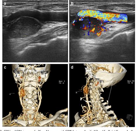 Figure 1 from Color Doppler Ultrasound in Diagnosis and Assessment of Carotid Body Tumors ...
