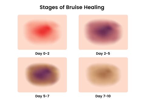 Think Outside the Ortho Box: A Case Study In Unexpected Bruising — ChiroUp