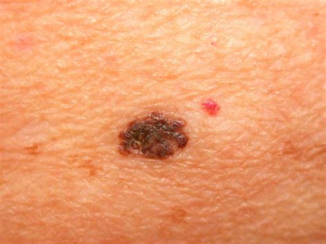 Early-Stage Melanoma: Skin Cancer Treatment