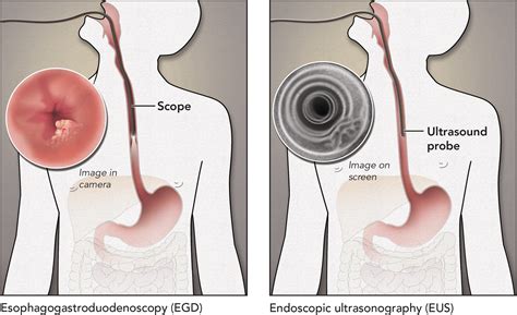 Esophageal Cancer Surgery