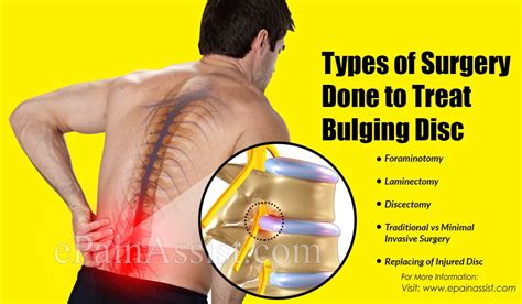 Bulging Disc Surgery 的图像结果