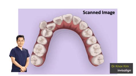 Invisalign Animation 的图像结果