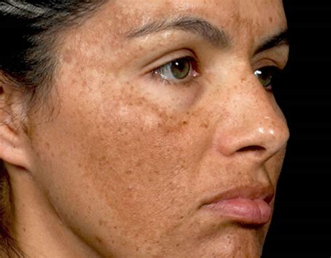 Melasma causes, symptoms, diagnosis & best treatment for melasma on face