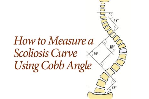 How Scoliosis Is Measured by the Cobb Angle
