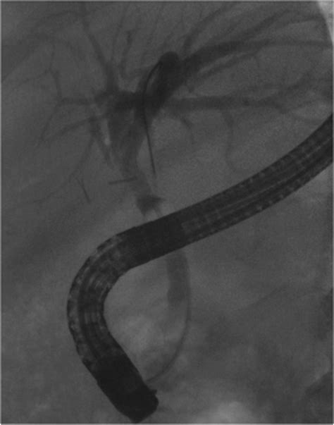 Endoscopic repair of surgically transected bile duct using overlapping covered metal stents ...